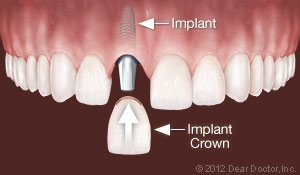 Replace One Tooth dental implant Lansing, MI