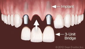Replace Multiple Teeth dental implant Lansing, MI