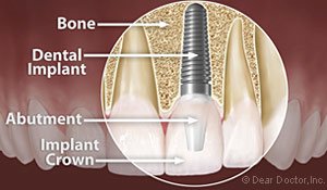 illustration of dental implant Lansing, MI