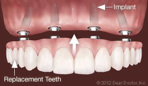Replace All Teeth Permanently Lansing, MI dental implants