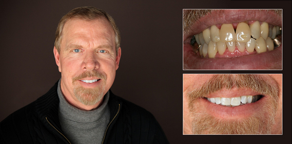 teeth whitening before and after dentist in Lansing, MI