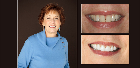 teeth whitening before and after dentist in lansing, mi