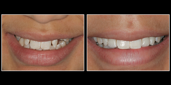 Dental Implants before and after in Lansing, MI Smile By
            Stone